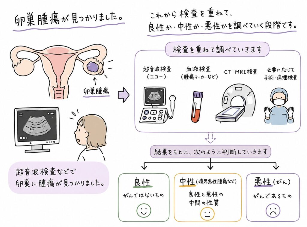 手描き風の図解。「卵巣腫瘍が見つかりました」という見出しとともに、子宮と卵巣のイラストで右側の卵巣に腫瘍がある様子を表示。超音波検査で腫瘍が見つかったことを示すイラストの後、矢印で「検査を重ねて調べていきます」と進み、超音波検査、血液検査、CT・MRI検査、必要に応じた手術・病理検査のイラストが並ぶ。最後に、検査結果によって「良性（がんではないもの）」「中性〈境界悪性腫瘍など〉（良性と悪性の中間の性質）」「悪性（がん）（がんであるもの）」の3つに分類される流れをわかりやすく示した医療インフォグラフィック。