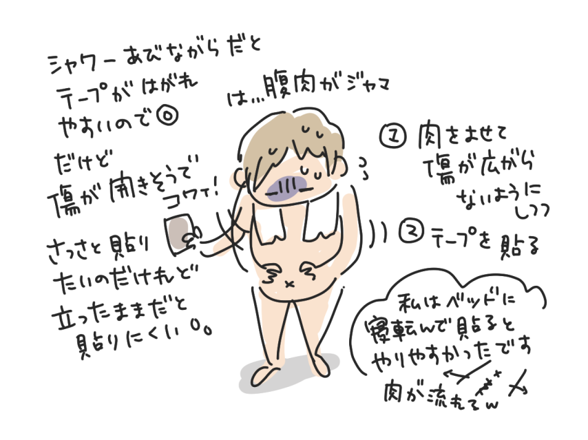 傷あとテープの貼り方。お腹の肉を寄せて傷が広がらないようにしながらテープを貼る。立ったままより、お風呂上がりにベッドに寝ころんで貼るほうがやりやすい