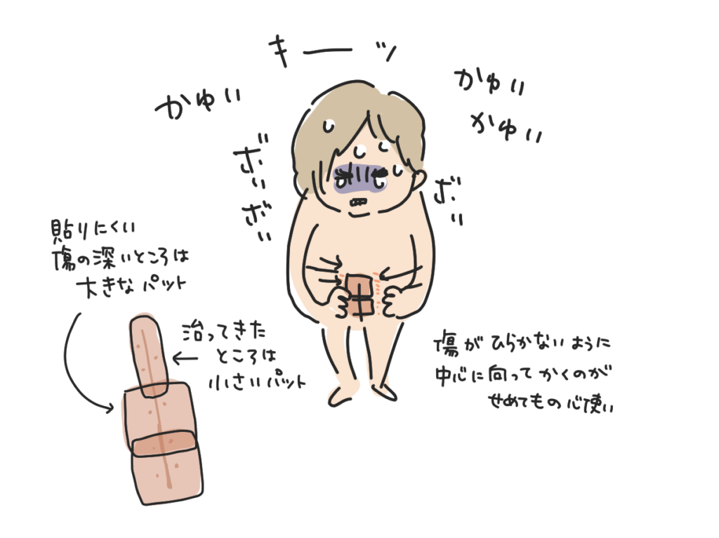 サージカルテープで傷のまわりがかゆくなった私。傷の深いところは大きなパッド、治ってきたところは小さいパッドで貼り分けている