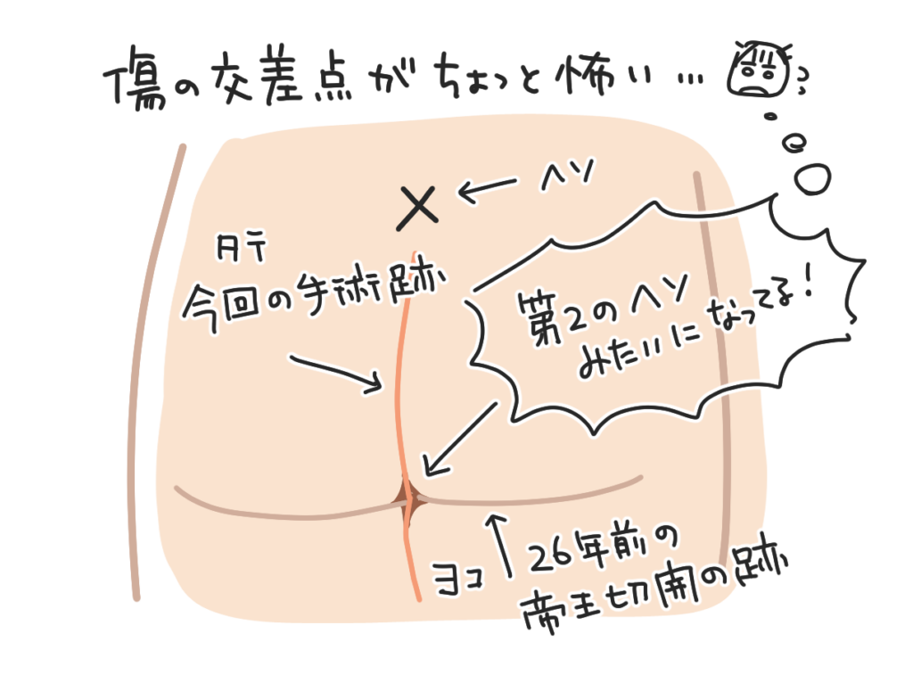 お腹の傷あとのイラスト。今回の手術の縦の傷と、26年前の帝王切開の横の傷が交差して、第2のへそのようになっている